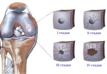 Гонартроз коленного сустава 1 степени: симптомы, диагностика и лечение заболевания