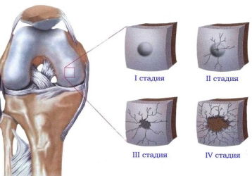 Гонартроз коленного сустава 1 степени: симптомы, диагностика и лечение заболевания