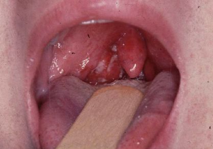 Почему возникает артрит после ангины: причины осложнений, тактика лечения и профилактики