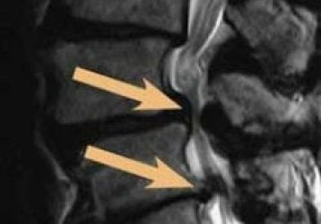 Виды, преимущества и недостатки иглоукалывания при грыже позвоночника