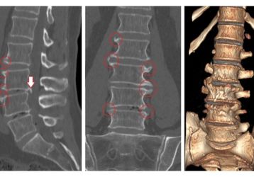 Лечебная гимнастика при остеохондрозе поясничного отдела позвоночника: комплексы физических упражнений