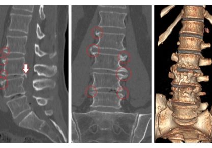 Основные принципы и методики реабилитации больных с остеохондрозом