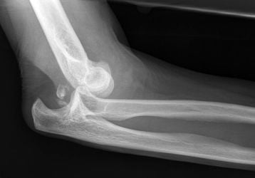 Вывих локтевого сустава: лечение, последствия и первая помощь