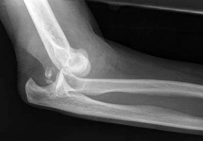 Вывих локтевого сустава: лечение, последствия и первая помощь