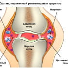 Гнойный артрит коленного и голеностопного суставов: симптомы и лечение