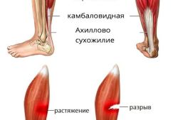 Что делать при растяжении мышц на ноге: симптомы травмирования, методики лечения