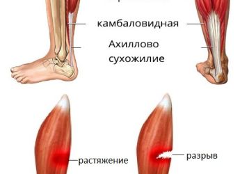 Что делать при растяжении мышц на ноге: симптомы травмирования, методики лечения