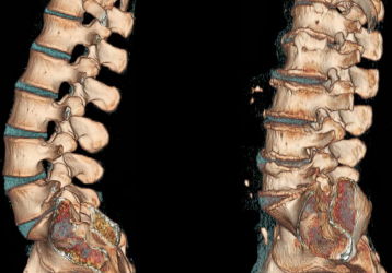 Причины, диагностика и лечение слабости в ногах при остеохондрозе