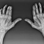 Артроз лучезапястного сустава: причины, симптомы, лечение