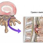 Основные техники массажа при грыже поясничного отдела позвоночника