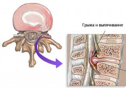 Основные техники массажа при грыже поясничного отдела позвоночника