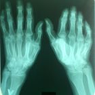 Лечение суставов пальцев рук: официальная медицина и народные методы