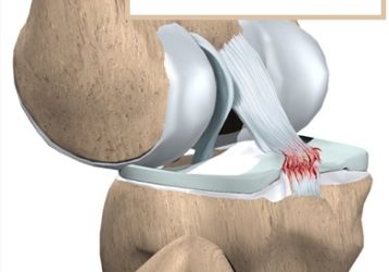 Разрыв задней крестообразной связки: причины, лечение и восстановление