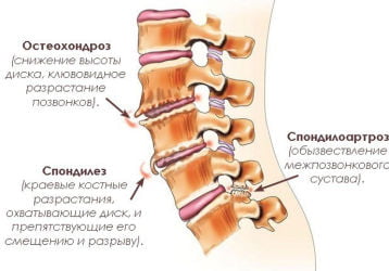 Лечение спондилоартроза пояснично-крестцового отдела позвоночника