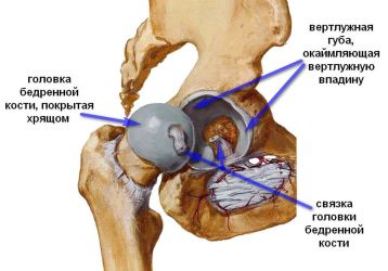 Лечение артроза тазобедренного сустава в домашних условиях