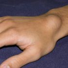 Шишки на суставах: причины, симптомы, разновидности