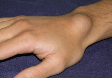 Шишки на суставах: причины, симптомы, разновидности