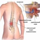 Лучшие рецепты народных средств лечения грыжи позвоночника