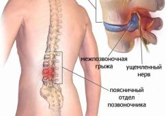 Причины и разновидности дорзальной грыжи диска — диагностика и лечение