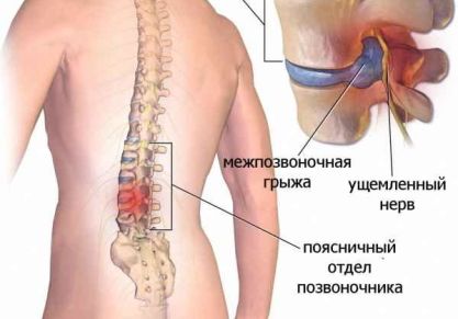 Лучшие рецепты народных средств лечения грыжи позвоночника