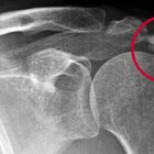 Воспаление сухожилий плечевого сустава или тендинит надостной мышцы: лечение, симптомы, формы и стадии заболевания