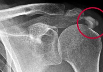 Воспаление сухожилий плечевого сустава или тендинит надостной мышцы: лечение, симптомы, формы и стадии заболевания