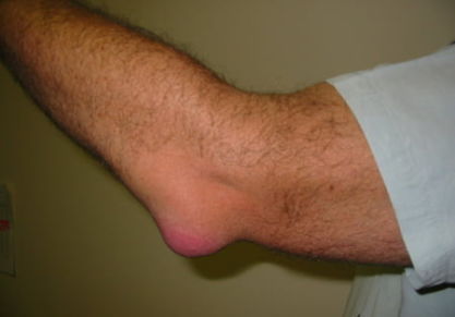 Гнойный бурсит локтевого сустава: симптомы и лечение медикаментами, операция