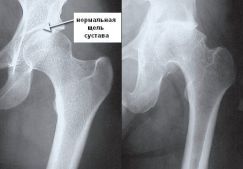 Массаж при коксартрозе тазобедренного сустава: правила выполнения, противопоказания, самомассаж
