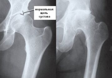 Массаж при коксартрозе тазобедренного сустава: правила выполнения, противопоказания, самомассаж