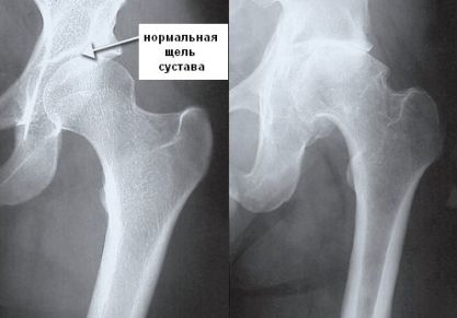 Чем опасно разрушение тазобедренного сустава: признаки и симптомы, тактика лечения