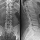 Рентген пояснично-крестцового отдела позвоночника: что показывает