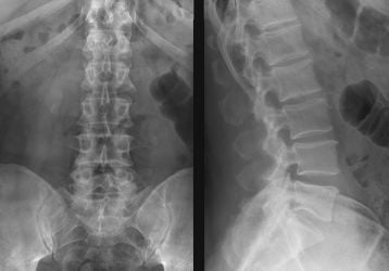 Рентген пояснично-крестцового отдела позвоночника: что показывает