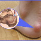 Что такое бурсит пятки. Причины, симптомы и лечение воспаления