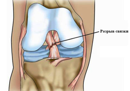 Реабилитация и восстановление после разрыва связок коленного сустава