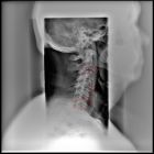 Йога при остеохондрозе шейного отдела позвоночника: какова эффективность?