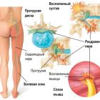 Вертеброгенная люмбалгия: описание заболевания и способов лечения