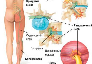 Вертеброгенная люмбалгия: описание заболевания и способов лечения