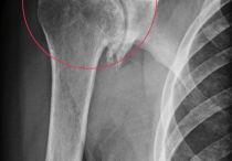 Как лечить артроз плечевого сустава в домашних условиях народными средствами