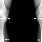 Остеоартроз суставов: симптомы, лечение и степени заболевания
