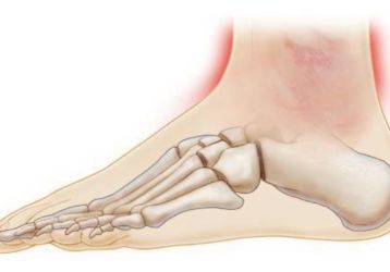 Ушиб голеностопного сустава: основные признаки, первая помощь, тактика лечения