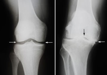 Народные средства лечение деформирующего артроза коленного сустава