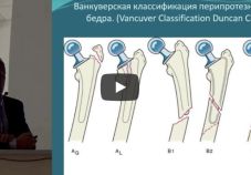 Видео: перипротезные переломы бедра. Современные подходы к лечению. Вишняков А.А. (Сургут)