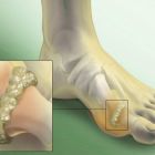 Подагрический артрит: лечение, причины и симптомы заболевания, диагностика, диета