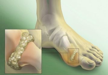 Подагрический артрит: лечение, причины и симптомы заболевания, диагностика, диета