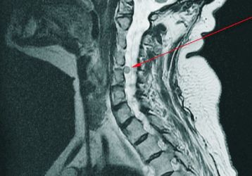 Народные средства для лечения грыжи шейного отдела позвоночника: лучшие рецепты и методики