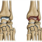 Симптомы и лечение деформирующего артроза голеностопного сустава