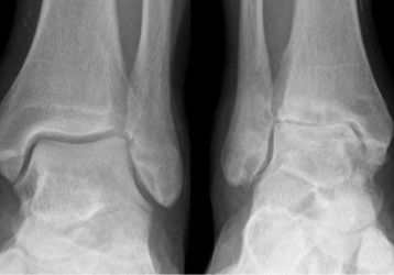 Народные средства в терапии остеоартроза голеностопного сустава: рецепты мазей, растирок, компрессов