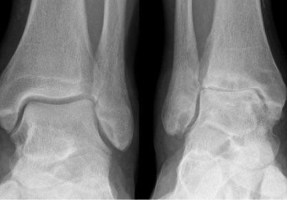 Артроз голеностопного сустава (голеностопа): симптомы и лечение, причины, описание болезни