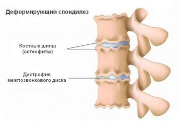 Деформирующий спондилез шейного отдела позвоночника