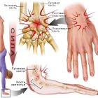 Как распознать и лечить растяжение связок кисти рук: медикаментозная и домашняя терапия